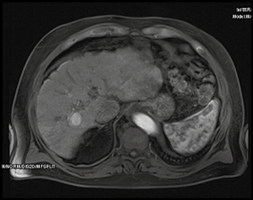 resonancia magnética hepática con contraste